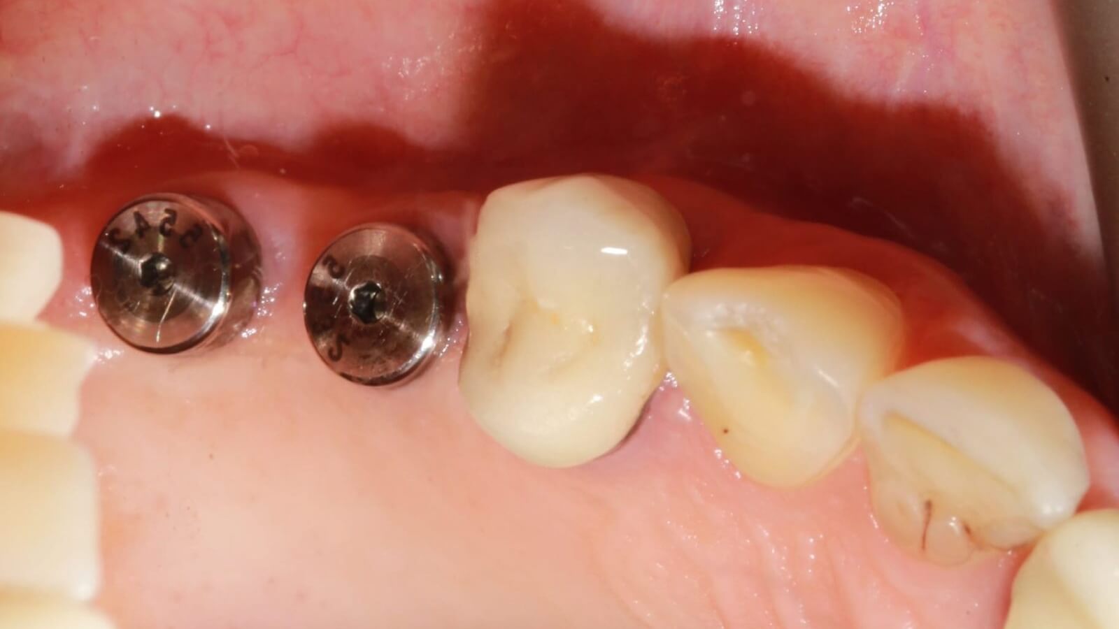 Імплантація зубів: від давніх часів до сучасності